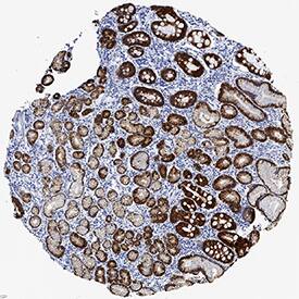 Cytokeratin 19 was detected in immersion fixed paraffin-embedded sections of human gastric cancer tissue using Mouse Anti-Human Cytokeratin 19 Monoclonal Antibody (Catalog # MAB35061) at 0.5 µg/mL for 1 hour at room temperature followed by incubation with the Anti-Mouse IgG VisUCyte™ HRP Polymer Antibody (Catalog # VC001). Tissue was stained using DAB (brown) and counterstained with hematoxylin (blue). Specific staining was localized to cytoplasm in gastric glands. View our protocol for IHC Staining with VisUCyte HRP Polymer Detection Reagents.