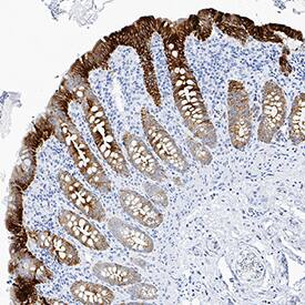 Cytokeratin 19 was detected in immersion fixed paraffin-embedded sections of human lymphoma tissue using Mouse Anti-Human Cytokeratin 19 Monoclonal Antibody (Catalog # MAB35061) at 0.5 µg/mL for 1 hour at room temperature followed by incubation with the Anti-Mouse IgG VisUCyte™ HRP Polymer Antibody (Catalog # VC001). Tissue was stained using DAB (brown) and counterstained with hematoxylin (blue). Specific staining was localized to cell surfaces. View our protocol for IHC Staining with VisUCyte HRP Polymer Detection Reagents.