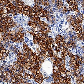 Cytokeratin 8 was detected in immersion fixed paraffin-embedded sections of human colon cancer tissue using Mouse Anti-Human Cytokeratin 8 Monoclonal Antibody (Catalog # MAB3165) at 1.7 µg/mL overnight at 4 °C. Tissue was stained using the Anti-Mouse HRP-DAB Cell & Tissue Staining Kit (brown; Catalog # CTS002) and counterstained with hematoxylin (blue). Specific staining was localized to plasma membranes. View our protocol for Chromogenic IHC Staining of Paraffin-embedded Tissue Sections.