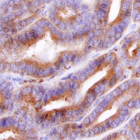 Cytosolic Sulfotransferase 2B1/SULT2B1 was detected in immersion fixed paraffin-embedded sections of human prostate using Mouse Anti-Human Cytosolic Sulfotransferase 2B1/SULT2B1 Monoclonal Antibody (Catalog # MAB6174) at 15 µg/mL overnight at 4 °C. Before incubation with the primary antibody, tissue was subjected to heat-induced epitope retrieval using Antigen Retrieval Reagent-Basic (Catalog # CTS013). Tissue was stained using the Anti-Mouse HRP-DAB Cell & Tissue Staining Kit (brown; Catalog # CTS002) and counterstained with hematoxylin (blue). Specific staining was localized to epithelial cells. View our protocol for Chromogenic IHC Staining of Paraffin-embedded Tissue Sections.