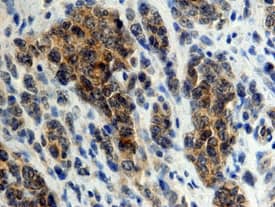 DC-SIGN+DC-SIGNR was detected in immersion fixed paraffin-embedded sections of human lymphoma using 25 µg/mL Mouse Anti-Human DC-SIGN+ DC-SIGNR Monoclonal Antibody (Catalog # MAB1621) overnight at 4 °C. Tissue was stained with the Anti-Mouse HRP-DAB Cell & Tissue Staining Kit (brown; Catalog # CTS002) and counter-stained with hematoxylin (blue). View our protocol for Chromogenic IHC Staining of Paraffin-embedded Tissue Sections.