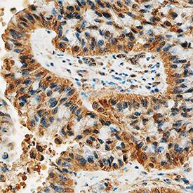 DDR2 was detected in immersion fixed paraffin-embedded sections of human lung cancer tissue using Mouse Anti-Human DDR2 Monoclonal Antibody (Catalog # MAB25381) at 15 µg/mL overnight at 4 °C. Tissue was stained using the Anti-Mouse HRP-DAB Cell & Tissue Staining Kit (brown; Catalog # CTS002) and counterstained with hematoxylin (blue). Specific staining was localized to cytoplasm. View our protocol for Chromogenic IHC Staining of Paraffin-embedded Tissue Sections.