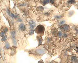 DDR2 was detected in immersion fixed paraffin-embedded sections of human lung using 25 &micro;g/mL Mouse Anti-Human DDR2 Monoclonal Antibody (Catalog # MAB2538) overnight at 4 &deg;C. Tissue was stained with the Anti-Mouse HRP-DAB Cell & Tissue Staining Kit (brown; Catalog # CTS002) and counterstained with hematoxylin (blue). Specific labeling was localized to to cells in connective tissue. View our protocol for Chromogenic IHC Staining of Paraffin-embedded Tissue Sections.