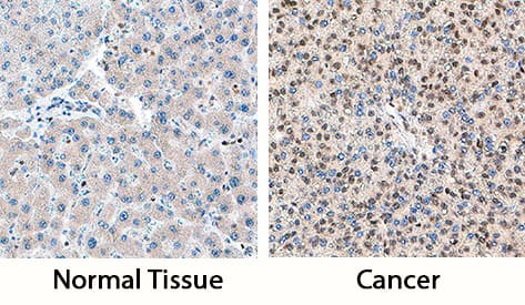 DDX17 was detected in immersion fixed paraffin-embedded sections of human liver cancer tissue using Goat Anti-Human DDX17 Antigen Affinity-purified Polyclonal Antibody (Catalog # AF4530) at 5 µg/mL overnight at 4 °C. Tissue was stained using the Anti-Goat HRP-DAB Cell & Tissue Staining Kit (brown; Catalog # CTS008) and counterstained with hematoxylin (blue). Specific staining was localized to nuclei in cancer cells. View our protocol for Chromogenic IHC Staining of Paraffin-embedded Tissue Sections.