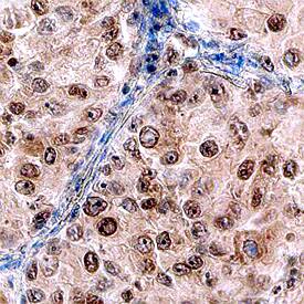 DOT1L was detected in immersion fixed paraffin-embedded sections of human lung using Human DOT1L Monoclonal Antibody (Catalog # MAB6546) at 15 µg/mL overnight at 4 °C. Before incubation with the primary antibody, tissue was subjected to heat-induced epitope retrieval using Antigen Retrieval Reagent-Basic (Catalog # CTS013). Tissue was stained using the Anti-Mouse HRP-DAB Cell & Tissue Staining Kit (brown; Catalog # CTS002) and counterstained with hematoxylin (blue). Specific staining was localized to nuclei. View our protocol for Chromogenic IHC Staining of Paraffin-embedded Tissue Sections.