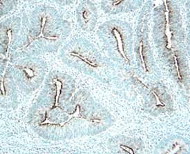 DcR3/TNFRSF6B was detected in immersion fixed paraffin-embedded sections of human stomach cancer using 10 &micro;g/mL Goat Anti-Human DcR3/TNFRSF6B Antigen Affinity-purified Polyclonal Antibody (Catalog # AF142) overnight at 4 &deg;C. Before incubation with the primary antibody tissue was subjected to heat-induced epitope retrieval using Antigen Retrieval Reagent-Basic (Catalog # CTS013). Tissue was stained with the Anti-Goat HRP-DAB Cell & Tissue Staining Kit (brown; Catalog # CTS008) and counterstained with hematoxylin (blue). Specific labeling was localized to the membrane of epithelial cells in gastric glands. View our protocol for Chromogenic IHC Staining of Paraffin-embedded Tissue Sections.