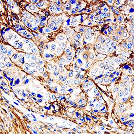 Decorin was detected in immersion fixed paraffin-embedded sections of human breast using Goat Anti-Human Decorin Antigen Affinity-purified Polyclonal Antibody (Catalog # AF143) at 15 µg/mL overnight at 4 °C. Tissue was stained using the Anti-Goat HRP-DAB Cell & Tissue Staining Kit (brown; (CTS008) and counterstained with hematoxylin (blue). Specific staining was localized to intralobular stromal tissue. View our protocol for Chromogenic IHC Staining of Paraffin-embedded Tissue Sections.