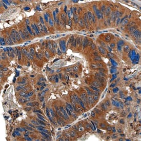Dihydrofolate Reductase/DHFR was detected in formalin fixed paraffin-embedded sections of human colon tissue using Mouse Anti-Human Dihydrofolate Reductase/DHFR Monoclonal Antibody (Catalog # MAB7934) at 15 µg/mL overnight at 4 °C. Tissue was stained using the Anti-Mouse HRP-DAB Cell & Tissue Staining Kit (brown; Catalog # CTS002) and counterstained with hematoxylin (blue). Specific staining was localized to the cytoplasm. View our protocol for Chromogenic IHC Staining of Paraffin-embedded Tissue Sections.