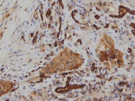 Dkk‑3 was detected in immersion fixed paraffin-embedded sections of human lung using Goat Anti-Human Dkk‑3 Biotinylated Antigen Affinity-purified Polyclonal Antibody (Catalog # BAF1118) at 15 &micro;g/mL overnight at 4 &deg;C. Tissue was stained using the Anti-Goat HRP-DAB Cell & Tissue Staining Kit (brown; CTS008) and counterstained with hematoxylin (blue). View our protocol for Chromogenic IHC Staining of Paraffin-embedded Tissue Sections.