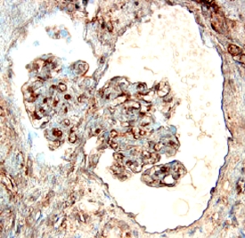 E-Selectin/CD62E was detected in immersion fixed paraffin-embedded sections of human kidney cancer tissue using Goat Anti-Human E-Selectin/ CD62E Polyclonal Antibody (Catalog # BBA18) overnight at 4 °C. Before incubation with the primary antibody tissue was subjected to heat-induced epitope retrieval using Antigen Retrieval Reagent-Basic (Catalog # CTS013). Tissue was stained (brown) and counterstained with hematoxylin (blue). View our protocol for Chromogenic IHC Staining of Paraffin-embedded Tissue Sections.