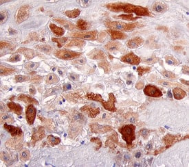 E2F‑1 was detected in immersion fixed paraffin-embedded sections of human placenta using 5 &micro;g/mL Sheep Anti-Human E2F‑1 Antigen Affinity-purified Polyclonal Antibody (Catalog # AF4825) overnight at 4 &deg;C. Tissue was stained with the Anti-Sheep HRP-DAB Cell & Tissue Staining Kit (brown; Catalog # CTS019) and counterstained with hematoxylin (blue). View our protocol for Chromogenic IHC Staining of Paraffin-embedded Tissue Sections.