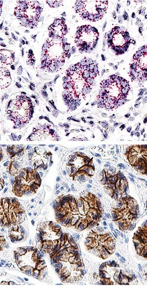 <b>Orthogonal Strategies Validation. </b>E-Cadherin mRNA was detected in formalin-fixed paraffin-embedded tissue sections of human stomach probed with ACD RNAScope®Probe (Catalog # 311091) and stained using ACD RNAscope®2.5 HD Detection Reagents-Red (top image, Catalog # 32260). Adjacent tissue section was processed for immunohistochemistry using R&D Systems Goat Anti-Human E-Cadherin Antigen Affinity-purified Polyclonal Antibody (Catalog # AF648) at 0.3 ug/mL for 1 hour at room temperature followed by incubation with the Anti-Goat IgG VisUCyte HRP Polymer Antibody (R&D Systems, Catalog # VC004) and DAB chromogen (lower image, yellow-brown). Tissues were counterstained with hematoxylin (blue).