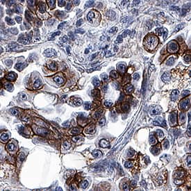Cadherin was detected in immersion fixed paraffin-embedded sections of human papillary serous cystadenocarcinoma of the colon using Mouse Anti-Human/Mouse Cadherin Pan Specific Monoclonal Antibody (Catalog # MAB18385) at 5 µg/mL for 1 hour at room temperature followed by incubation with the Anti-Mouse IgG VisUCyte™ HRP Polymer Antibody (VC001). Before incubation with the primary antibody, tissue was subjected to heat-induced epitope retrieval using Antigen Retrieval Reagent-Basic (CTS013). Tissue was stained using DAB (brown) and counterstained with hematoxylin (blue). Specific staining was localized to plasma membrane. View our protocol for IHC Staining with VisUCyte HRP Polymer Detection Reagents.