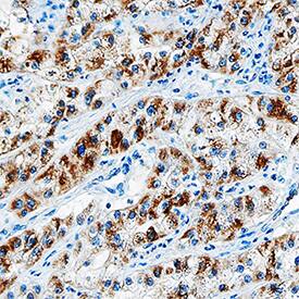EGF was detected in immersion fixed paraffin-embedded sections of human lung cancer tissue using Mouse Anti-Human/Primate EGF Monoclonal Antibody (Catalog # MAB636) at 15 µg/mL overnight at 4 °C. Tissue was stained using the Anti-Mouse HRP-DAB Cell & Tissue Staining Kit (brown; Catalog # CTS002) and counterstained with hematoxylin (blue). Specific staining was localized to the plasma membrane and cytoplasm. View our protocol for Chromogenic IHC Staining of Paraffin-embedded Tissue Sections.