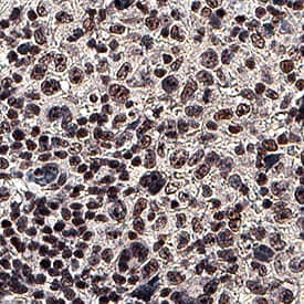 EGR1 was detected in immersion fixed paraffin-embedded sections of human Hodgkin's Lymphoma using Rat Anti-Human EGR1 Monoclonal Antibody (Catalog # MAB28181) at 5 µg/mL for 1 hour at room temperature followed by incubation with the Anti-Mouse IgG VisUCyte™ HRP Polymer Antibody (Catalog # VC001). Before incubation with the primary antibody, tissue was subjected to heat-induced epitope retrieval using Antigen Retrieval Reagent-Basic (Catalog # CTS013). Tissue was stained using DAB (brown) and counterstained with hematoxylin (blue). Specific staining was localized to nuclei. View our protocol for IHC Staining with VisUCyte HRP Polymer Detection Reagents.