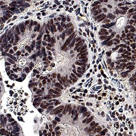 EGR1 was detected in immersion fixed paraffin-embedded sections of human adenocarcinoma tissue using Rat Anti-Human EGR1 Monoclonal Antibody (Catalog # MAB28181) at 5 µg/mL for 1 hour at room temperature followed by incubation with the Anti-Mouse IgG VisUCyte™ HRP Polymer Antibody (Catalog # VC001). Before incubation with the primary antibody, tissue was subjected to heat-induced epitope retrieval using Antigen Retrieval Reagent-Basic (Catalog # CTS013). Tissue was stained using DAB (brown) and counterstained with hematoxylin (blue). Specific staining was localized to nuclei. View our protocol for IHC Staining with VisUCyte HRP Polymer Detection Reagents.
