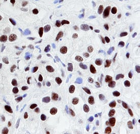 EGR1 was detected in immersion fixed paraffin-embedded sections of human prostate cancer tissue using 15 &micro;g/mL Rat Anti-Human EGR1 Monoclonal Antibody (Catalog # MAB2818) overnight at 4 &deg;C. Before incubation with the primary antibody tissue was subjected to heat-induced epitope retrieval using Antigen Retrieval Reagent-Basic (Catalog # CTS013). Tissue was stained with the Anti-Rat HRP-DAB Cell & Tissue Staining Kit (brown; Catalog # CTS017) and counterstained with hematoxylin (blue). View our protocol for Chromogenic IHC Staining of Paraffin-embedded Tissue Sections.