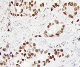 EGR1 was detected in immersion fixed paraffin-embedded sections of human prostate cancer tissue using 15 &micro;g/mL Rat Anti-Human EGR1 Monoclonal Antibody (Catalog # MAB2818) overnight at 4 &deg;C. Before incubation with the primary antibody tissue was subjected to heat-induced epitope retrieval using Antigen Retrieval Reagent-Basic (Catalog # CTS013). Tissue was stained with the Anti-Rat HRP-DAB Cell & Tissue Staining Kit (brown; Catalog # CTS017) and counterstained with hematoxylin (blue). View our protocol for Chromogenic IHC Staining of Paraffin-embedded Tissue Sections.