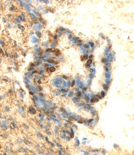 ERK3 was detected in immersion fixed paraffin-embedded sections of human breast cancer tissue using 8 &micro;g/mL Mouse Anti-Human ERK3 Monoclonal Antibody (Catalog # MAB3196) overnight at 4 &deg;C. Tissue was stained with the Anti-Mouse HRP-DAB Cell & Tissue Staining Kit (brown; Catalog # CTS002) and counterstained with hematoxylin (blue). View our protocol for Chromogenic IHC Staining of Paraffin-embedded Tissue Sections.