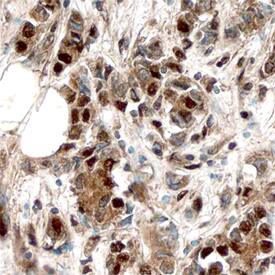 ERa/NR3A1 was detected in immersion fixed paraffin-embedded sections of human breast using Mouse Anti-Human ERa/NR3A1 Monoclonal Antibody (Catalog # MAB57152) at 15 µg/mL overnight at 4 °C. Before incubation with the primary antibody, tissue was subjected to heat-induced epitope retrieval using Antigen Retrieval Reagent-Basic (Catalog # CTS013). Tissue was stained using the Anti-Mouse HRP-DAB Cell & Tissue Staining Kit (brown; Catalog # CTS002) and counterstained with hematoxylin (blue). Specific staining was localized to nuclei. View our protocol for Chromogenic IHC Staining of Paraffin-embedded Tissue Sections.