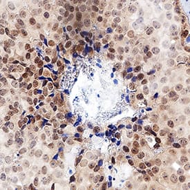 ERa/NR3A1 was detected in immersion fixed paraffin-embedded sections of human breast cancer tissue using Rabbit Anti-Human ERa/NR3A1 Monoclonal Antibody (Catalog # MAB57153) at 10 µg/mL for 1 hour at room temperature followed by incubation with the Anti-Rabbit IgG VisUCyte™ HRP Polymer Antibody (Catalog # VC003). Before incubation with the primary antibody, tissue was subjected to heat-induced epitope retrieval using Antigen Retrieval Reagent-Basic (Catalog # CTS013). Tissue was stained using DAB (brown) and counterstained with hematoxylin (blue). Specific staining was localized to cell nuclei. View our protocol for IHC Staining with VisUCyte HRP Polymer Detection Reagents.