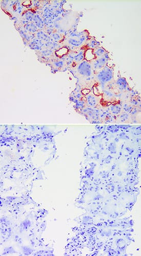 E-Selectin/CD62E was detected in acetone fixed cryosections of human kidney tissue using Goat Anti-Human E-Selectin/CD62E Polyclonal Antibody (Catalog # BBA18) overnight at 4 ° C. Tissues were stained with rabbit anti-goat secondary antibody and HRP polymer-conjugated anti-rabbit IgG followed by AEC+Substrate Chromogen (red) followed by counterstaining with hematoxylin (blue). Before incubation with the primary antibody, tissues were treatedex vivowith LPS and also treated to block endogenous peroxidase activity. The lower panel shows an absence of labeling when primary antibody is omitted. Experiments were carried out and images were provided by Dr. Grietje Molema, University of Groningen, The Netherlands.