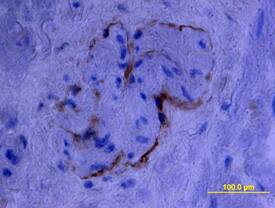 Endoglin/CD105 was detected in immersion fixed paraffin-embedded sections of human prostate using Goat Anti-Human Endoglin/CD105 Biotinylated Antigen Affinity-purified Polyclonal Antibody (Catalog # BAF1097) at 15 µg/mL overnight at 4 °C. Tissue was stained using the Anti-Goat HRP-DAB Cell & Tissue Staining Kit (brown; Catalog # CTS008) and counterstained with hematoxylin (blue). View our protocol for Chromogenic IHC Staining of Paraffin-embedded Tissue Sections.