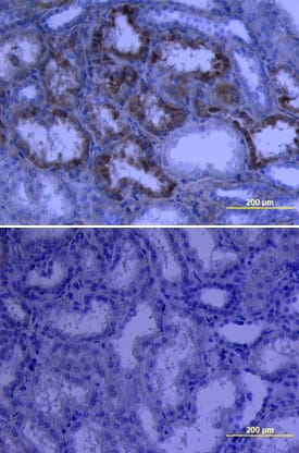 Endostatin was detected in immersion fixed paraffin-embedded sections of human kidney cancer tissue using Goat Anti-Human Endostatin Biotinylated Antigen Affinity-purified Polyclonal Antibody (Catalog # BAF1098) at 15 µg/mL overnight at 4 °C. Tissue was stained using the Anti-Goat HRP-DAB Cell & Tissue Staining Kit (brown; Catalog # CTS008) and counterstained with hematoxylin (blue). Lower panel shows a lack of labeling if primary antibodies are omitted and tissue is stained only with secondary antibody followed by incubation with detection reagents. View our protocol for Chromogenic IHC Staining of Paraffin-embedded Tissue Sections.