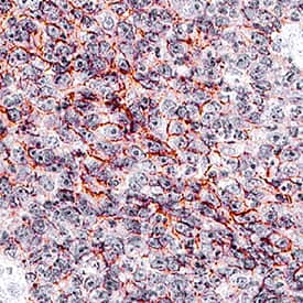 EpCAM/TROP-1 was detected in immersion fixed paraffin-embedded sections of human colon using Goat Anti-Human EpCAM/TROP-1 Antigen Affinity-purified Polyclonal Antibody (Catalog # AF960) at 0.3 µg/mL for 1 hour at room temperature followed by incubation with the Anti-Goat IgG VisUCyte™ HRP Polymer Antibody (VC004). Before incubation with the primary antibody, tissue was subjected to heat-induced epitope retrieval using Antigen Retrieval Reagent-Basic (Catalog # CTS013). Tissue was stained using DAB (brown) and counterstained with hematoxylin (blue). Specific staining was localized to cytoplasm and plasma membrane. View our protocol for IHC Staining with VisUCyte HRP Polymer Detection Reagents.