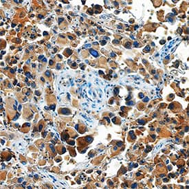 Ephrin-A5 was detected in immersion fixed paraffin-embedded sections of human melanoma using Goat Anti-Human Ephrin-A5 Antigen Affinity-purified Polyclonal Antibody (Catalog # AF3743) at 15 µg/mL overnight at 4 °C. Tissue was stained using the Anti-Goat HRP-DAB Cell & Tissue Staining Kit (brown; Catalog # CTS008) and counterstained with hematoxylin (blue). Specific staining was localized to cytoplasm. View our protocol for Chromogenic IHC Staining of Paraffin-embedded Tissue Sections.
