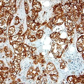 ErbB2/Her2 was detected in immersion fixed paraffin-embedded sections of human breast cancer tissue using Goat Anti-Human ErbB2/Her2 Antigen Affinity-purified Polyclonal Antibody (Catalog # AF1129) at 1.7 µg/mL overnight at 4 °C. Tissue was stained using the Anti-Goat HRP-DAB Cell & Tissue Staining Kit (brown; Catalog # CTS008) and counterstained with hematoxylin (blue). Specific staining was localized to epithelial cells. View our protocol for Chromogenic IHC Staining of Paraffin-embedded Tissue Sections.