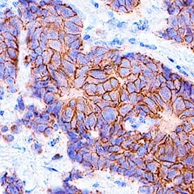 <b>Biological Strategies Validation. </b>ErbB2/Her2 was detected in immersion fixed paraffin-embedded sections of human breast cancer tissue using Rabbit Anti-Human Phospho-ErbB2/Her2 (Y1248) Antigen Affinity-purified Polyclonal Antibody (Catalog # AF1768) at 0.3 µg/mL for 1 hour at room temperature followed by incubation with the Anti-Rabbit IgG VisUCyte™ HRP Polymer Antibody (VC003). Before incubation with the primary antibody, tissue was subjected to heat-induced epitope retrieval using Antigen Retrieval Reagent-Basic (VCTS021). Tissue was stained using DAB (brown) and counterstained with hematoxylin (blue). Specific staining was localized to plasma membrane. View our protocol for IHC Staining with VisUCyte HRP Polymer Detection Reagents.