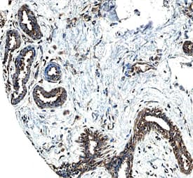 ErbB2/Her2 was detected in immersion fixed paraffin-embedded sections of human breast cancer tissue using Rabbit Anti-Human Phospho-ErbB2/Her2 (Y1196) Antigen Affinity-purified Polyclonal Antibody (Catalog # AF4438) at 15 &micro;g/mL overnight at 4 &deg;C. Tissue was stained using the Anti-Rabbit HRP-DAB Cell & Tissue Staining Kit (brown; Catalog # CTS005) and counterstained with hematoxylin (blue). View our protocol for Chromogenic IHC Staining of Paraffin-embedded Tissue Sections.