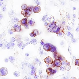 ErbB2/Her2 was detected in immersion fixed paraffin-embedded sections of human breast cancer tissue using Goat Anti-Human ErbB2/Her2 Biotinylated Antigen Affinity-purified Polyclonal Antibody (Catalog # BAF1129) at 15 µg/mL overnight at 4 °C. Tissue was stained using the Anti-Goat HRP-DAB Cell & Tissue Staining Kit (brown; Catalog # CTS008) and counterstained with hematoxylin (blue). Specific staining was localized to plasma membrane. View our protocol for Chromogenic IHC Staining of Paraffin-embedded Tissue Sections.
