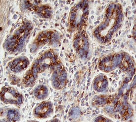 ErbB2/Her2 was detected in immersion fixed paraffin-embedded sections of human breast using Mouse Anti-Human ErbB2/Her2 Herstatin Isoform Monoclonal Antibody (Catalog # MAB11291) at 25 µg/mL overnight at 4 °C. Tissue was stained using the Anti-Mouse HRP-DAB Cell & Tissue Staining Kit (brown; Catalog # CTS002) and counterstained with hematoxylin (blue). View our protocol for Chromogenic IHC Staining of Paraffin-embedded Tissue Sections.