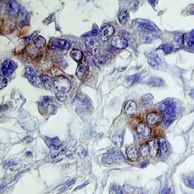 ErbB2/Her2 was detected in immersion fixed paraffin-embedded sections of human breast cancer tissue using Mouse Anti-Human ErbB2/Her2 Herstatin Isoform Monoclonal Antibody (Catalog # MAB11291) at 8 &micro;g/mL overnight at 4 &deg;C. Tissue was stained using the Anti-Mouse HRP-DAB Cell & Tissue Staining Kit (brown; Catalog # CTS002) and counterstained with hematoxylin (blue). Specific labeling was localized to the cytoplasm of cancer cells. View our protocol for Chromogenic IHC Staining of Paraffin-embedded Tissue Sections.