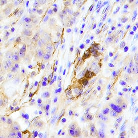 ErbB2/Her2 was detected in immersion fixed paraffin-embedded sections of human breast cancer tissue using Mouse Anti-Human ErbB2/Her2 Monoclonal Antibody (Catalog # MAB1129) at 15 µg/mL overnight at 4 °C. Tissue was stained using the Anti-Mouse HRP-DAB Cell & Tissue Staining Kit (brown; Catalog # CTS002) and counterstained with hematoxylin (blue). Specific staining was localized to epithelial cells. View our protocol for Chromogenic IHC Staining of Paraffin-embedded Tissue Sections.
