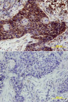 ErbB3/Her3 was detected in immersion fixed paraffin-embedded sections of human lung array using Mouse Anti-Human ErbB3/Her3 Monoclonal Antibody (Catalog # MAB3483) at 15 µg/mL overnight at 4 °C. Tissue was stained using the Anti-Mouse HRP-DAB Cell & Tissue Staining Kit (brown; Catalog # CTS002) and counterstained with hematoxylin (blue). Lower panel shows a lack of labeling if primary antibodies are omitted and tissue is stained only with secondary antibody followed by incubation with detection reagents. View our protocol for Chromogenic IHC Staining of Paraffin-embedded Tissue Sections.