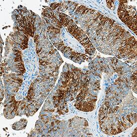 FABP4/A-FABP was detected in immersion fixed paraffin-embedded sections of human bladder cancer tissue using Goat Anti-Human FABP4/A-FABP Antigen Affinity-purified Polyclonal Antibody (Catalog # AF3150) at 3 µg/mL overnight at 4 °C. Tissue was stained using the Anti-Goat HRP-DAB Cell & Tissue Staining Kit (brown; CTS008) and counterstained with hematoxylin (blue). Specific staining was localized to cytoplasm. View our protocol for Chromogenic IHC Staining of Paraffin-embedded Tissue Sections.