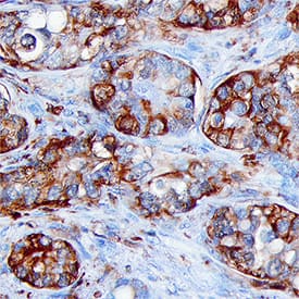 FBPase 1 was detected in immersion fixed paraffin-embedded sections of human liver cancer tissue using Sheep Anti-Human/Mouse/Rat FBPase 1 Antigen Affinity-purified Polyclonal Antibody (Catalog # AF7285) at 15 µg/mL for 1 hour at room temperature followed by incubation with the Anti-Sheep IgG VisUCyte™ HRP Polymer Antibody (Catalog # VC006). Tissue was stained using DAB (brown) and counterstained with hematoxylin (blue). Specific staining was localized to cytoplasm in cancer cells. View our protocol for IHC Staining with VisUCyte HRP Polymer Detection Reagents.