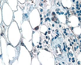 FGF-3 was detected in immersion fixed paraffin-embedded sections of human breast cancer tissue using 10 µg/mL Goat Anti-Human FGF-3 Antigen Affinity-purified Polyclonal Antibody (Catalog # AF1206) overnight at 4 °C. Before incubation with the primary antibody tissue was subjected to heat-induced epitope retrieval using Antigen Retrieval Reagent-Basic (CTS013). Tissue was stained with the Anti-Goat HRP-DAB Cell & Tissue Staining Kit (brown; CTS008) and counterstained with hematoxylin (blue). View our protocol for Chromogenic IHC Staining of Paraffin-embedded Tissue Sections.