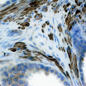 FGF-8 was detected in immersion fixed paraffin-embedded sections of human prostate using Mouse Anti-Human/Mouse FGF-8 Monoclonal Antibody (Catalog # MAB323) at 25 µg/mL overnight at 4 °C. Tissue was stained using the Anti-Mouse HRP-DAB Cell & Tissue Staining Kit (brown; Catalog # CTS002) and counterstained with hematoxylin (blue). Specific staining was localized to stromal cell cytoplasm. View our protocol for Chromogenic IHC Staining of Paraffin-embedded Tissue Sections.