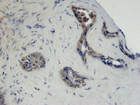 FGF R2 was detected in immersion fixed paraffin-embedded sections of human adenocarcinoma using Mouse Anti-Human FGF R2 Monoclonal Antibody (Catalog # MAB6843) at 25 &micro;g/mL overnight at 4 &deg;C. Tissue was stained using the Anti-Mouse HRP-DAB Cell & Tissue Staining Kit (brown; Catalog # CTS002) and counterstained with hematoxylin (blue). View our protocol for Chromogenic IHC Staining of Paraffin-embedded Tissue Sections.