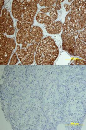 FGF basic/FGF2/bFGF was detected in immersion fixed paraffin-embedded sections of human ovarian array using Human FGF basic/FGF2/bFGF Biotinylated Antigen Affinity-purified Polyclonal Antibody (Catalog # BAF233) at 10 µg/mL overnight at 4 °C. Tissue was stained using the Anti-Goat HRP-DAB Cell & Tissue Staining Kit (brown; Catalog # CTS008) and counterstained with hematoxylin (blue). Lower panel shows a lack of labeling if primary antibodies are omitted and tissue is stained only with secondary antibody followed by incubation with detection reagents. View our protocol for Chromogenic IHC Staining of Paraffin-embedded Tissue Sections.