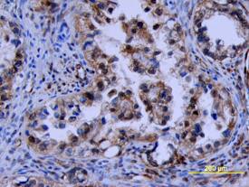 FGF basic/FGF2/bFGF was detected in immersion fixed paraffin-embedded sections of human ovarian cancer tissue using Human FGF basic/FGF2/bFGF Biotinylated Antigen Affinity-purified Polyclonal Antibody (Catalog # BAF233) at 10 µg/mL overnight at 4 °C. Tissue was stained using the Anti-Goat HRP-DAB Cell & Tissue Staining Kit (brown; Catalog # CTS008) and counterstained with hematoxylin (blue). View our protocol for Chromogenic IHC Staining of Paraffin-embedded Tissue Sections.