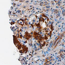 FLIP was detected in immersion fixed paraffin-embedded sections of human pancreatic cancer tissue using Mouse Anti-Human/Mouse/Rat FLIP Monoclonal Antibody (Catalog # MAB8430) at 15 µg/mL overnight at 4 °C. Tissue was stained using the Anti-Mouse HRP-DAB Cell & Tissue Staining Kit (brown; Catalog # CTS002) and counterstained with hematoxylin (blue). Specific staining was localized to cytoplasm of cells in islets. View our protocol for Chromogenic IHC Staining of Paraffin-embedded Tissue Sections.