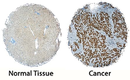 FRS2 was detected in immersion fixed paraffin-embedded sections of human normal liver and liver cancer tissue using Sheep Anti-Human FRS2 Antigen Affinity-purified Polyclonal Antibody (Catalog # AF4069) at 1 µg/mL overnight at 4 °C. Tissue was stained using the Anti-Sheep HRP-DAB Cell & Tissue Staining Kit (brown; Catalog # CTS019) and counterstained with hematoxylin (blue). Specific staining was localized to cancer cell cytoplasm and cell membranes. View our protocol for Chromogenic IHC Staining of Paraffin-embedded Tissue Sections.