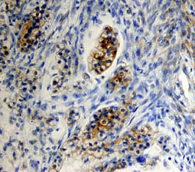 FSH R was detected in immersion fixed paraffin-embedded sections of human ovarian cancer tissue using Human FSH R Monoclonal Antibody (Catalog # MAB6559) at 15 µg/mL overnight at 4 °C. Tissue was stained using the Anti-Mouse HRP-DAB Cell & Tissue Staining Kit (brown; Catalog # CTS002) and counterstained with hematoxylin (blue). Specific staining was localized to cytoplasm. View our protocol for Chromogenic IHC Staining of Paraffin-embedded Tissue Sections.