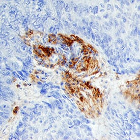 Fibroblast Activation Protein a/FAP was detected in immersion fixed paraffin-embedded sections of human squamous cell carcinoma using Sheep Anti-Human Fibroblast Activation Protein a/FAP Antigen Affinity-purified Polyclonal Antibody (Catalog # AF3715) at 15 µg/mL overnight at 4 °C. Tissue was stained using the Anti-Sheep HRP-DAB Cell & Tissue Staining Kit (brown; Catalog # CTS019) and counterstained with hematoxylin (blue). Specific staining was localized to connective tissue. View our protocol for Chromogenic IHC Staining of Paraffin-embedded Tissue Sections.