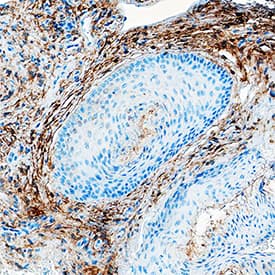 Fibroblast Activation Protein  alpha /FAP was detected in immersion fixed paraffin-embedded sections of human basal cell carcinoma using Sheep Anti-Human Fibroblast Activation Protein  alpha /FAP Antigen Affinity-purified Polyclonal Antibody (Catalog # AF3715) at 10 µg/mL overnight at 4 °C. Tissue was stained using the Anti-Sheep HRP-DAB Cell & Tissue Staining Kit (brown; Catalog # CTS019) and counterstained with hematoxylin (blue). Specific staining was localized to cytoplasm. View our protocol for Chromogenic IHC Staining of Paraffin-embedded Tissue Sections.